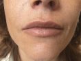 Augmentation des lèvres - Cliché avant - Dr Christine Luneau