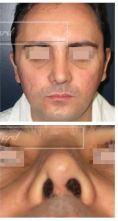 Septoplastie (opération de la cloison nasale) - Cliché avant
