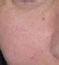 Suppression des veines par laser (taches de naissances, rougeurs) - couperose joue,  résultat après une séance de laser
