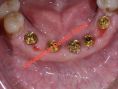 Implants dentaires - Cliché avant - Dr Bouattour Mohamed Amine