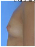 Lipofilling mammaire - Cliché avant - Dr Thierry Lemaire