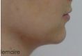 Chirurgie du double-menton - Résultat d’une liposuccion douce du cou chez une femme de 25 ans. Dr Lemaire, Paris