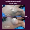 Augmentation mammaire (Implants mammaires) - Cliché avant - Dr Karim Bouzid