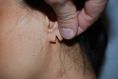 Otoplastie (Chirurgie esthétique des oreilles) - Réparation de lobe d