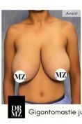 Réduction mammaire - Cliché avant - Professeur Mourad Zinelabidine