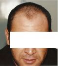 Greffe de cheveux - Cliché avant - Dr Nizar Abouda