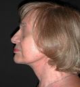 Lifting du visage - Femme, 70 ans, résultat à 3 mois post-opératoire.
Technique : lifting profond cervico-facial, avec suspension du SMAS