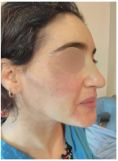 Lifting du visage - Cliché avant - Docteur Hayet Zitoun Esthétique