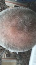 Greffe de cheveux - Greffe de cheveux, FUE avec assistance robotisée par sa fer neograft. Pas de cicatrices, les greffons sont pris un par un et réimplantés un par un.