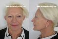 Lifting du visage - femme de 61 ans
lifting du visage et du cou