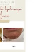 Correction du double menton non invasif - Cliché avant - Dr Catherine de Goursac