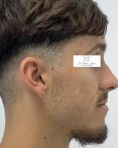 Génioplastie - Chirurgie esthétique du menton - Les décalages de classe 3 (prognathe mandibulaire / rétrognathe maxillaire) présentent souvent des asymétries faciales : déviation latérales du bas du visage, obliquité du sourire…. Il faut en tenir compte ! Résultat à 6 mois post ostéotomie Bimaxillaire