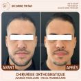 Chirurgie réparatrice du visage - Cliché avant - Dr Sirine Tritar