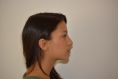 Rhinoplastie - Rhinoplastie par voie externe avec réduction de bosse osseuse et travail de la pointe nasale