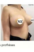 Lifting mammaire (Mastopexie) - Cliché avant - Professeur chef de service Mourad Zinelabidine Président de la société tunisienne de chirurgie esthétique