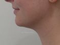 Chirurgie du double-menton - Une liposuccion douce  du cou effectuée sous anesthésie locale a permis de supprimer le double menton et de bien dessiner l