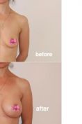 Augmentation mammaire (Implants mammaires) - Cliché avant - Dr Xavier Tenorio