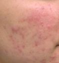 Traitement acné - laser - Cliché avant - Dr Xavier Tenorio