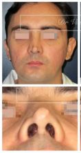 Septoplastie (opération de la cloison nasale) - Cliché avant