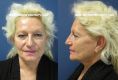 Lifting du visage - femme de 61 ans
lifting du visage et du cou