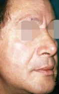 Rhinoplastie - Cliché avant - Dott. Andrea La Padula M.D.
