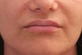 Augmentation des lèvres - Cliché avant - Dr Marianne AUQUE
