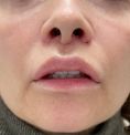 Augmentation des lèvres - Le Lift lips est une technique simple pour remonter la lèvre et donner plus de volume sans injection.