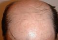 Greffe de cheveux - Cliché avant - Dr Richard Aziza