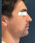 Génioplastie - Chirurgie esthétique du menton - la génioplastie peut être réalisée :
-Seule
-En complément d’une ostéotomie des mâchoires
-En complément d’une rhinoplastie (profiloplastie)
-En complément de prothèses d’angles mandibulaires (virilisation faciale)