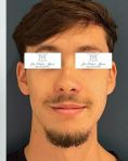 Rhinoplastie - Les décalages de classe 3 (prognathe mandibulaire / rétrognathe maxillaire) présentent souvent des asymétries faciales : déviation latérales du bas du visage, obliquité du sourire…. Il faut en tenir compte Résultat à 6 mois post ostéotomie Bimaxillaire