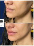 Dr Romain Viard - Augmentation des lèvres par acide hyaluronique. 
Résultat pendant 10 mois environ. Procédure indolore par l’application d’une puissante crème anesthésiante.
