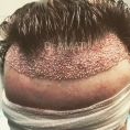 Dr Richard Amat Centre de Micro-greffe de cheveux FUE - Technique FUE micro greffe capillaire sans cicatrice et sans douleur