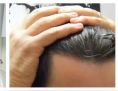 Greffe de cheveux - Cliché avant