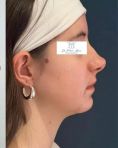 Dr Frédéric Barere - A partir de quel âge opérer les jeunes patients en chirurgie Maxillo-faciale ?
-Pour la génioplastie : environ 12 ans
-Pour la chirurgie des mâchoires en arrière : environ 14 / 15 ans
-Pour la chirurgie des mâchoires en avant : environ 17 / 18 ans (fin de croissance)
-Pour la Rhinoplastie environ 17 / 18 ans (maturité psychologique …)
Ici, patiente opérée d’une ostéotomie avancée de la mandibule. Résultat à 8 mois.