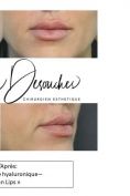 Augmentation des lèvres (acide hyaluronique) - Cliché avant - Dr Christophe Desouches