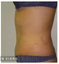 Liposuccion - Résultat à 6 mois d’une abdominoplastie avec cure de diastasis des muscles grands droits de l’abdomen.