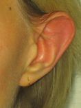 Otoplastie (Chirurgie esthétique des oreilles) - Cliché avant - Dr Nicolas Froget