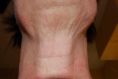 Traitement galvanique (Nu Skin Galvanic spa system ™ )  – revitalisation de la peau - Cliché avant - Dr Franck Benhamou