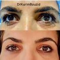 Blépharoplastie - Cliché avant - Dr Karim Bouzid