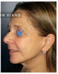 Lifting du visage - Lifting cervico facial chez une femme de 58 ans qui faisait plus âgée que son âge. L’intervention lui a permis de retrouver un visage plus harmonieux.