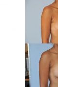 Augmentation mammaire (Implants mammaires) - Cliché avant - Dr Anne Kolbe & Dr Jean-François Baron & Dr Nadia Djeridi