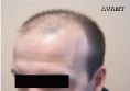 Greffe de cheveux - Cliché avant - Docteur GRANGÉ-PRADERAS