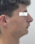 Dr Frédéric Barere - Résultat à 6 mois ostéotomie avancée mandibulaire