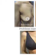 Augmentation mammaire (Implants mammaires) - Cliché avant - Dr Karim Bouzid