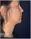 Génioplastie - Chirurgie esthétique du menton - Cliché avant - Dr Romain Viard