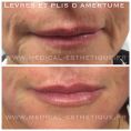 Augmentation des lèvres (acide hyaluronique) - Cliché avant - Dr Richard Amat Centre de Micro-greffe de cheveux FUE