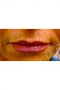 Augmentation des lèvres - Cliché avant - Dr Laurent Oddou