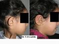 Otoplastie (Chirurgie esthétique des oreilles) - Cliché avant - Dr Tayeb Essadok