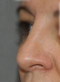 Rhinoplastie - Restructuration de la pointe du nez. Modification des cartilages alaires et de la projection