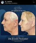 Augmentation des lèvres - Cliché avant - Dr Julien Vanaret